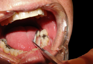 cavity filling tooth teeth